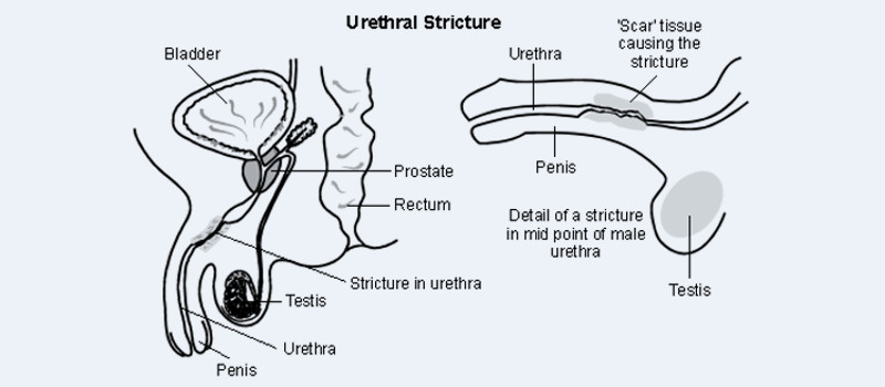 kidney stone disease 1